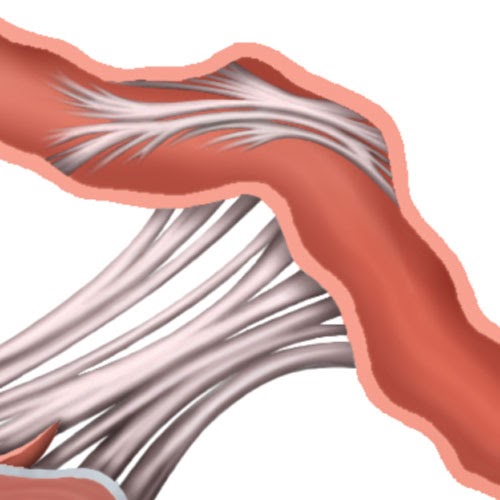 image of adhesion inside fallopian tube
