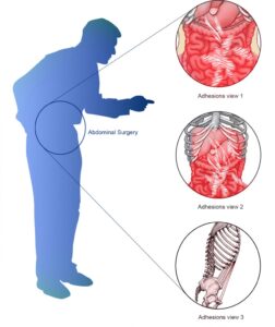 What Causes Lower Abdominal Pain in Males? In this case this shows an image of a man having pains due to adhesions.