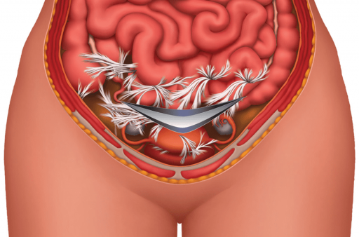 adhered-pevlis-artwork-final.png
